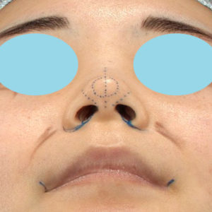 「耳介軟骨移植＋鼻尖縮小（close法）＋小鼻縮小+α」　新宿ラクル美容外科クリニック　２０代女性　デザイン　７月２３日