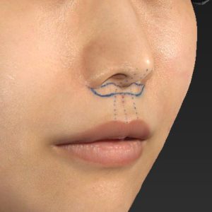 新宿ラクル美容外科クリニック　山本厚志　「人中短縮術（リップリフト）」　デザイン　７月２４日