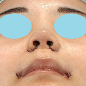 「耳介軟骨移植＋鼻尖縮小（close法）＋小鼻縮小+α」　新宿ラクル美容外科クリニック　２０代女性　手術直後　７月２３日