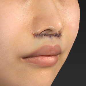 新宿ラクル美容外科クリニック　山本厚志　「人中短縮術（リップリフト）」　手術直後　７月２４日