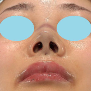 「耳介軟骨移植＋鼻尖縮小（close法）＋鼻プロテーゼ隆鼻術＋ハンプ切除＋猫手術＋真皮脂肪移植（鼻尖）」　新宿ラクル美容外科クリニック　２０代女性　手術直後　７月２６日