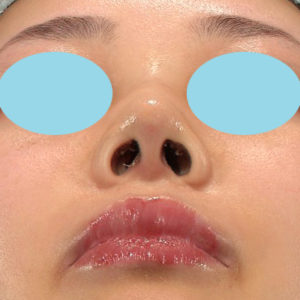 「耳介軟骨移植＋鼻尖縮小（close法）＋鼻プロテーゼ隆鼻術＋ハンプ切除＋猫手術＋真皮脂肪移植（鼻尖）」　新宿ラクル美容外科クリニック　２０代女性　手術後１週間目　７月２６日