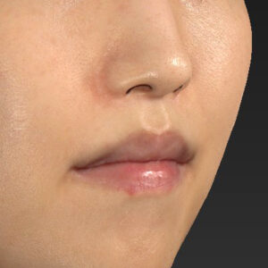 新宿ラクル美容外科クリニック　山本厚志　「人中短縮術（リップリフト）＋口角挙上（スマイルリップ）」　手術後１２ヶ月目　１月９日