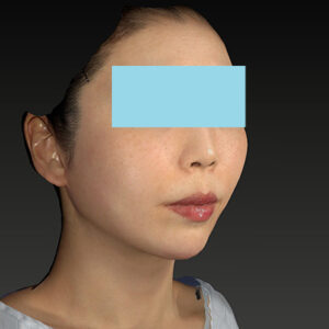 新宿ラクル美容外科クリニック　山本厚志　「ナチュラルフェイスネックリフト」「ライポライフ脂肪吸引（ジョールファット+あご下）」　手術後１２ヶ月目　１月２１日