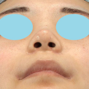 「耳介軟骨移植＋鼻尖縮小（close法）＋小鼻縮小+α」　新宿ラクル美容外科クリニック　２０代女性　手術後１ヶ月目　７月２３日