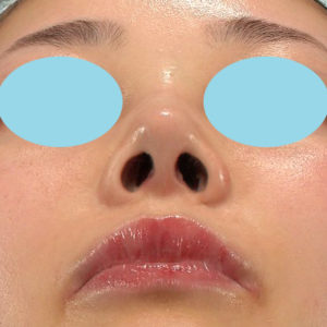 「耳介軟骨移植＋鼻尖縮小（close法）＋鼻プロテーゼ隆鼻術＋ハンプ切除＋猫手術＋真皮脂肪移植（鼻尖）」　新宿ラクル美容外科クリニック　２０代女性　手術後１ヶ月目　７月２６日