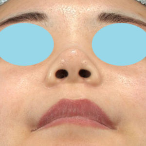 「耳介軟骨移植＋鼻尖縮小（close法）＋小鼻縮小+α」　新宿ラクル美容外科クリニック　２０代女性　手術後２ヶ月目　７月２３日