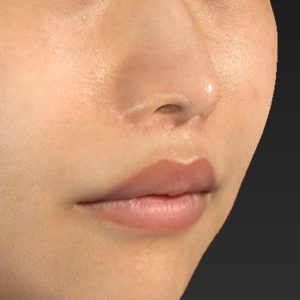 新宿ラクル美容外科クリニック　山本厚志　「人中短縮術（リップリフト）」　手術後２ヶ月目　７月２４日