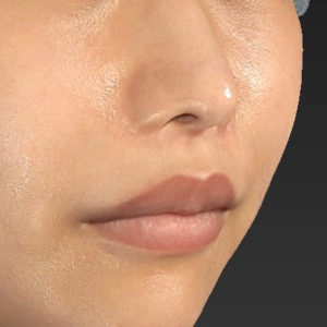 新宿ラクル美容外科クリニック　山本厚志　「人中短縮術（リップリフト）」　手術後３ヶ月目　７月２４日