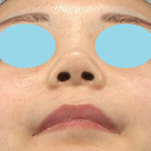 「耳介軟骨移植＋鼻尖縮小（close法）＋小鼻縮小+α」　新宿ラクル美容外科クリニック　２０代女性　手術後３ヶ月目　８月３１日