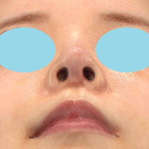 「鼻中隔延長修正＋耳介軟骨移植修正＋鼻尖形成修正＋小鼻縮小＋α法修正＋鼻柱下降＋猫手術＋真皮脂肪移植（鼻尖）」　新宿ラクル美容外科クリニック　２０代女性　手術後６ヶ月目　１０月１日