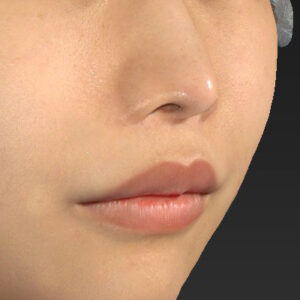 新宿ラクル美容外科クリニック　山本厚志　「人中短縮術（リップリフト）」　手術後６ヶ月目　１１月１７日