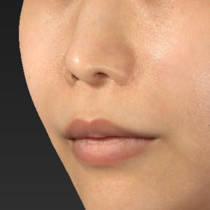 新宿ラクル美容外科クリニック　山本厚志　「人中短縮術（リップリフト）」　手術前　７月２４日