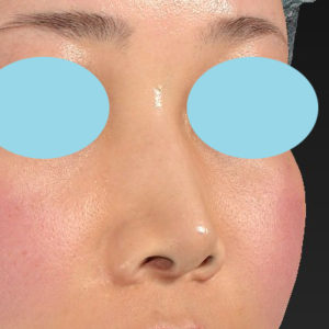 「耳介軟骨移植＋鼻尖縮小（close法）＋鼻プロテーゼ隆鼻術＋ハンプ切除＋猫手術＋真皮脂肪移植（鼻尖）」　新宿ラクル美容外科クリニック　２０代女性　手術前　７月２６日