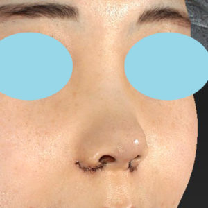 「耳介軟骨移植＋鼻尖縮小（close法）＋小鼻縮小+α」　新宿ラクル美容外科クリニック　２０代女性　手術直後　７月２３日