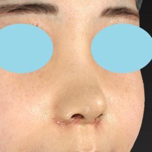 「耳介軟骨移植＋鼻尖縮小（close法）＋小鼻縮小+α」　新宿ラクル美容外科クリニック　２０代女性　手術後１週間目　７月２３日