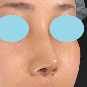 「耳介軟骨移植＋鼻尖縮小（close法）＋鼻プロテーゼ隆鼻術＋ハンプ切除＋猫手術＋真皮脂肪移植（鼻尖）」　新宿ラクル美容外科クリニック　２０代女性　手術後１週間目　７月２６日