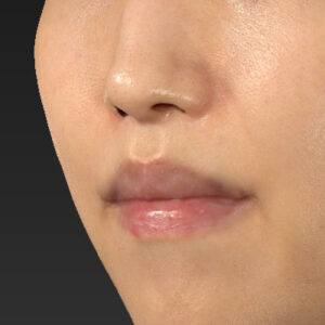 新宿ラクル美容外科クリニック　山本厚志　「人中短縮術（リップリフト）＋口角挙上（スマイルリップ）」　手術後１２ヶ月目　１月９日