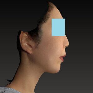 新宿ラクル美容外科クリニック　山本厚志　「ナチュラルフェイスネックリフト」「ライポライフ脂肪吸引（ジョールファット+あご下）」　手術後１２ヶ月目　１月２１日