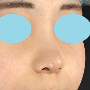 「耳介軟骨移植＋鼻尖縮小（close法）＋小鼻縮小+α」　新宿ラクル美容外科クリニック　２０代女性　手術後１ヶ月目　７月２３日