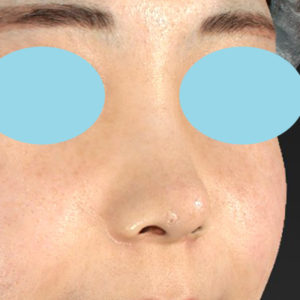 「耳介軟骨移植＋鼻尖縮小（close法）＋小鼻縮小+α」　新宿ラクル美容外科クリニック　２０代女性　手術後２ヶ月目　７月２３日