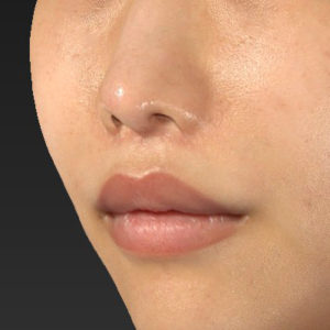 新宿ラクル美容外科クリニック　山本厚志　「人中短縮術（リップリフト）」　手術後２ヶ月目　７月２４日