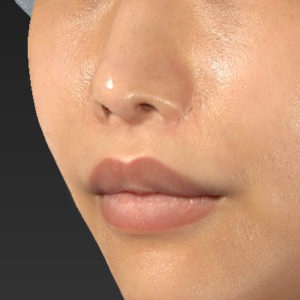 新宿ラクル美容外科クリニック　山本厚志　「人中短縮術（リップリフト）」　手術後３ヶ月目　７月２４日