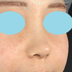 「耳介軟骨移植＋鼻尖縮小（close法）＋小鼻縮小+α」　新宿ラクル美容外科クリニック　２０代女性　手術後３ヶ月目　８月３１日