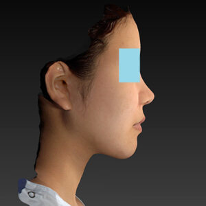 新宿ラクル美容外科クリニック　山本厚志　ナチュラルフェイスリフト　手術後６ヶ月目　１０月２日