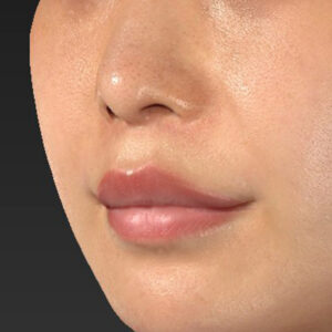 新宿ラクル美容外科クリニック　山本厚志　「人中短縮術（リップリフト）＋口角挙上（スマイルリップ）」　手術後６ヶ月目　１０月６日