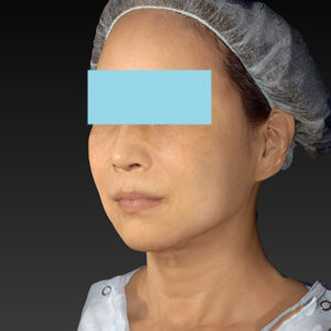 新宿ラクル美容外科クリニック　山本厚志　「アルテミスリフト」　手術後６ヶ月目　１月２５日