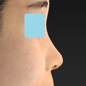 「耳介軟骨移植＋鼻尖縮小（close法）＋小鼻縮小+α」　新宿ラクル美容外科クリニック　２０代女性　手術前　７月２３日