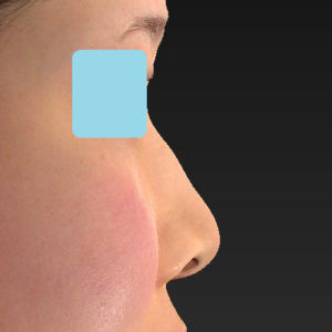 「耳介軟骨移植＋鼻尖縮小（close法）＋鼻プロテーゼ隆鼻術＋ハンプ切除＋猫手術＋真皮脂肪移植（鼻尖）」　新宿ラクル美容外科クリニック　２０代女性　手術前　７月２６日