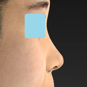 「耳介軟骨移植＋鼻尖縮小（close法）＋小鼻縮小+α」　新宿ラクル美容外科クリニック　２０代女性　デザイン　７月２３日