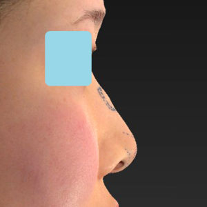 「耳介軟骨移植＋鼻尖縮小（close法）＋鼻プロテーゼ隆鼻術＋ハンプ切除＋猫手術＋真皮脂肪移植（鼻尖）」　新宿ラクル美容外科クリニック　２０代女性　デザイン　７月２６日