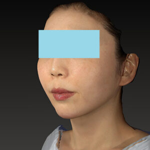 新宿ラクル美容外科クリニック　山本厚志　「ナチュラルフェイスネックリフト」「ライポライフ脂肪吸引（ジョールファット+あご下）」　手術後１２ヶ月目　１月２１日