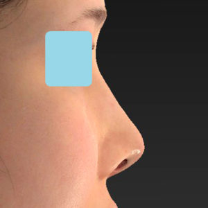 「耳介軟骨移植＋鼻尖縮小（close法）＋鼻プロテーゼ隆鼻術＋ハンプ切除＋猫手術＋真皮脂肪移植（鼻尖）」　新宿ラクル美容外科クリニック　２０代女性　手術後１ヶ月目　７月２６日