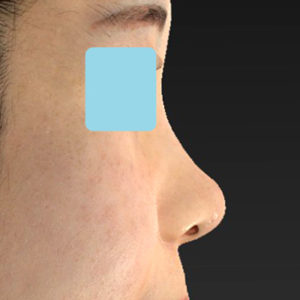 「耳介軟骨移植＋鼻尖縮小（close法）＋小鼻縮小+α」　新宿ラクル美容外科クリニック　２０代女性　手術後２ヶ月目　７月２３日