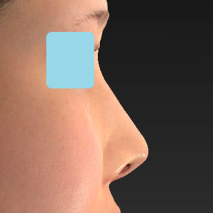 「耳介軟骨移植＋鼻尖縮小（close法）＋鼻プロテーゼ隆鼻術＋ハンプ切除＋猫手術＋真皮脂肪移植（鼻尖）」　新宿ラクル美容外科クリニック　２０代女性　手術後２ヶ月目　７月２６日