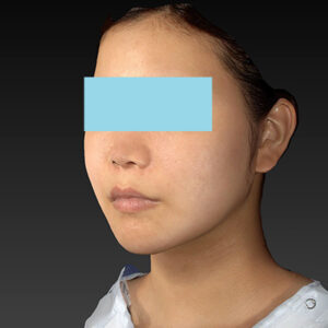 新宿ラクル美容外科クリニック　山本厚志　ナチュラルフェイスリフト　手術後６ヶ月目　１０月２日