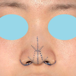 「小鼻縮小+α＋鼻尖縮小（close法）」　新宿ラクル美容外科クリニック　２０代女性　デザイン　８月１９日