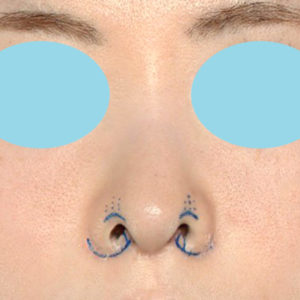 新宿ラクル美容外科クリニック　山本厚志　「小鼻縮小+α法 ＋ 鼻孔縁下降術」　デザイン　８月１２日