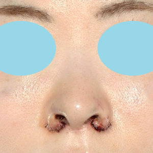 新宿ラクル美容外科クリニック　山本厚志　「小鼻縮小+α法 ＋ 鼻孔縁下降術」　手術直後　８月１２日