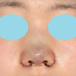 「小鼻縮小+α＋鼻尖縮小（close法）」　新宿ラクル美容外科クリニック　２０代女性　手術直後　８月１９日