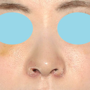 新宿ラクル美容外科クリニック　山本厚志　「小鼻縮小+α法 ＋ 鼻孔縁下降術」　手術後１週間目　８月１２日