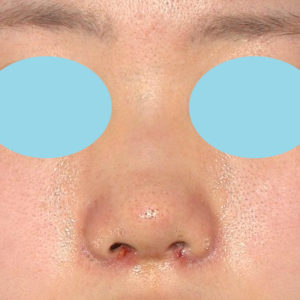 「小鼻縮小+α＋鼻尖縮小（close法）」　新宿ラクル美容外科クリニック　２０代女性　手術後１週間目　８月１９日