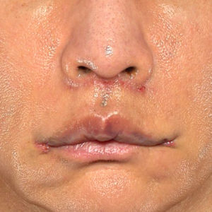 新宿ラクル美容外科クリニック　山本厚志　「人中短縮術（リップリフト）＋口角挙上（スマイルリップ）」　手術後１週間目　８月２０日