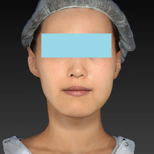 新宿ラクル美容外科クリニック　山本厚志　「アルテミスリフト」　手術後１週間目　８月５日