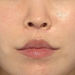 新宿ラクル美容外科クリニック　山本厚志　「人中短縮術（リップリフト）＋口角挙上（スマイルリップ）」　手術後１２ヶ月目　１２月２７日