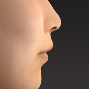 新宿ラクル美容外科クリニック　山本厚志　「猫手術（鼻唇角形成術）+ 貴族手術（鼻翼基部プロテーゼ）+ 口角挙上（スマイルリフト）+ 人中短縮術（リップリフト）」　手術後１２ヶ月目　２月１６日